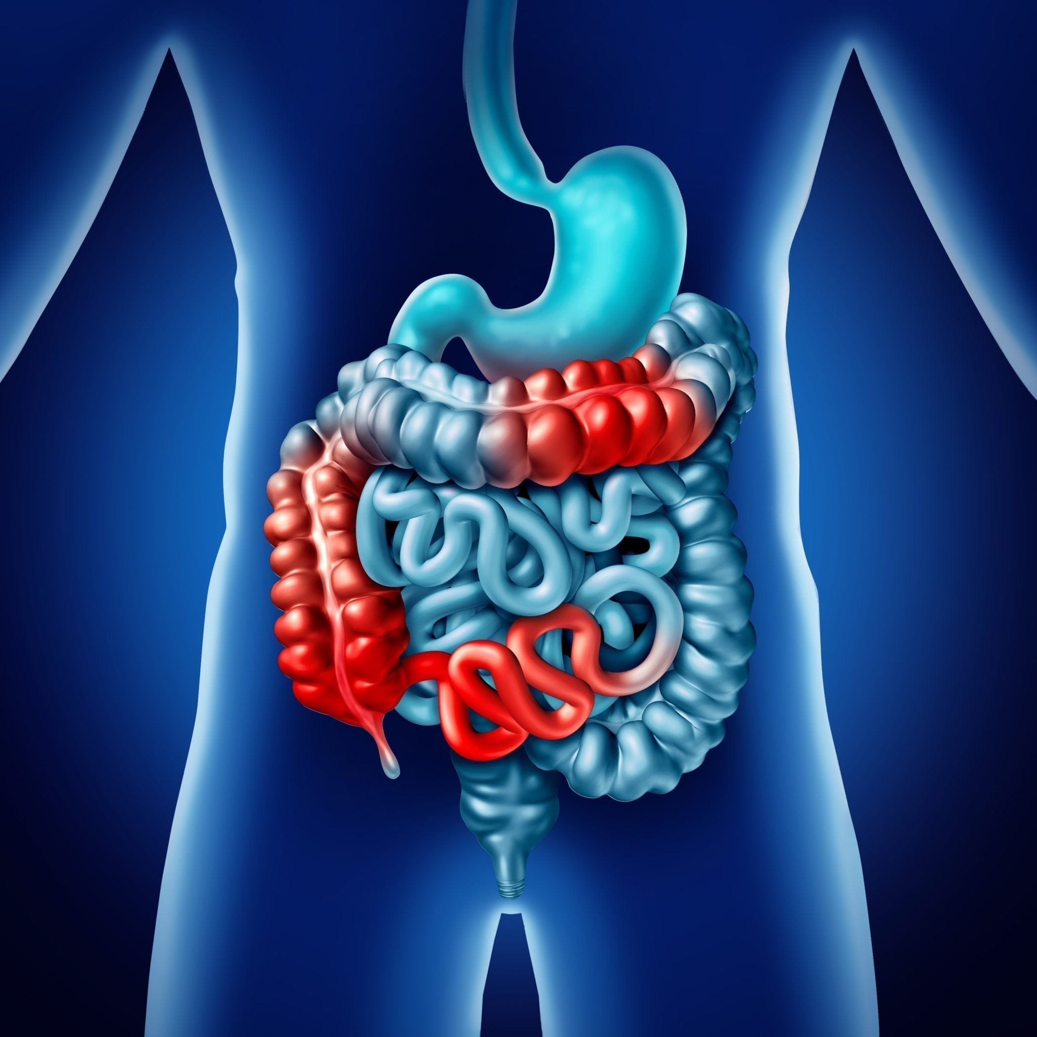 Inflammatory Bowel Disease: Link Between Vitamin D Deficiency and Inflammation